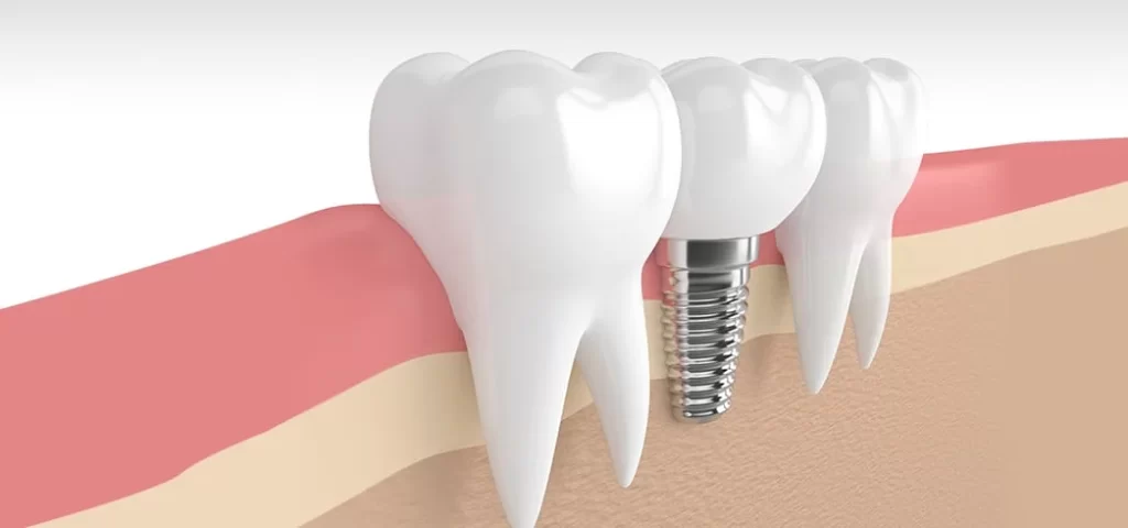 Dental Implants